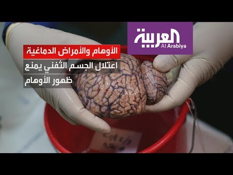 شاهد باحثون روس يكشفون علاقة بين الأوهام وأمراض دماغية أخرى