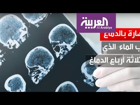 تضرر خلايا المخ بسبب التوتر العاطفي