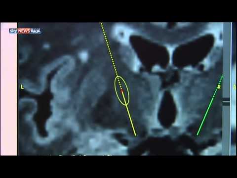 علاج جديد لمرضى الشلل الرعاشيّ